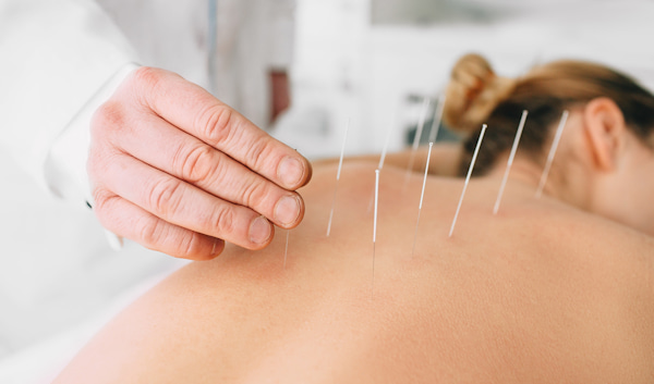 Acupuncture Surrey or delta BC