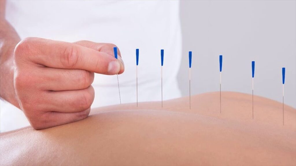 Acupuncture Surrey BC – A Natural Solution to Your Health Concerns