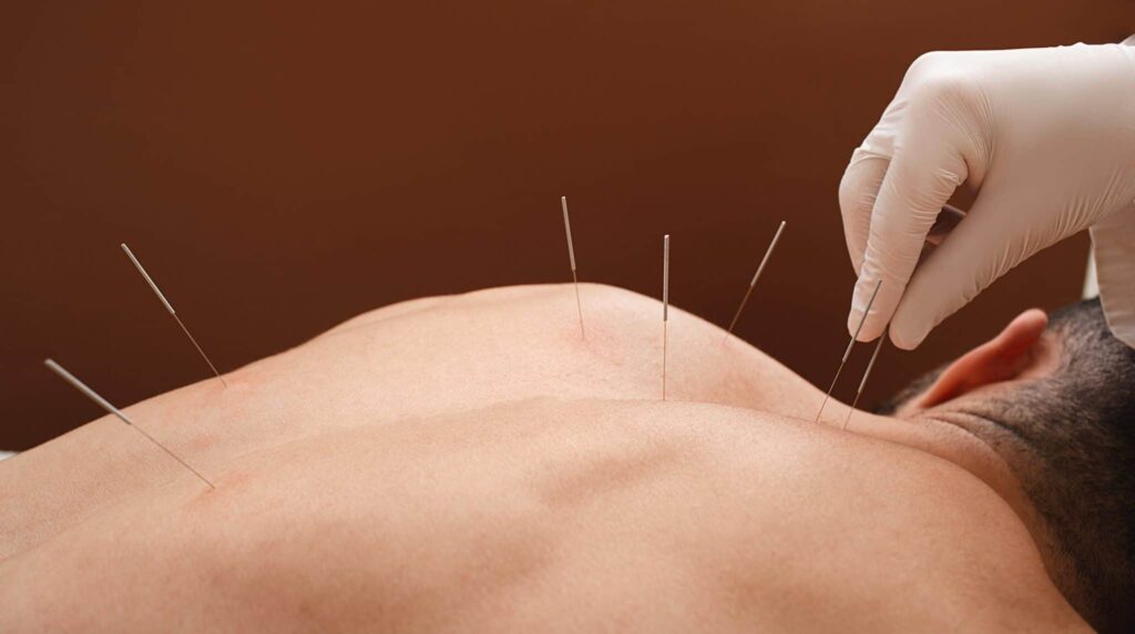 The Science Behind Acupuncture: