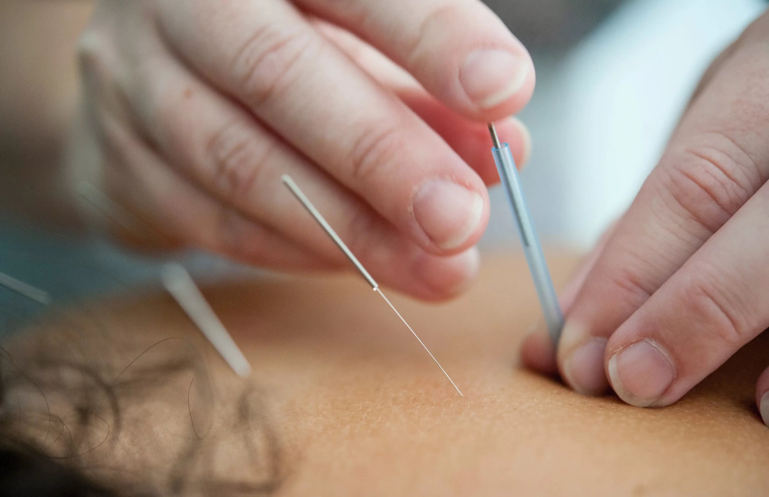 Can-Acupuncture-Help-With-Migraines-Here’s-What-Science-Says