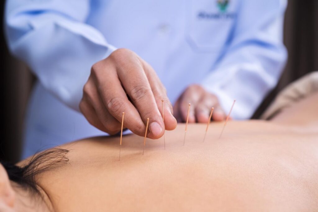 acupuncture